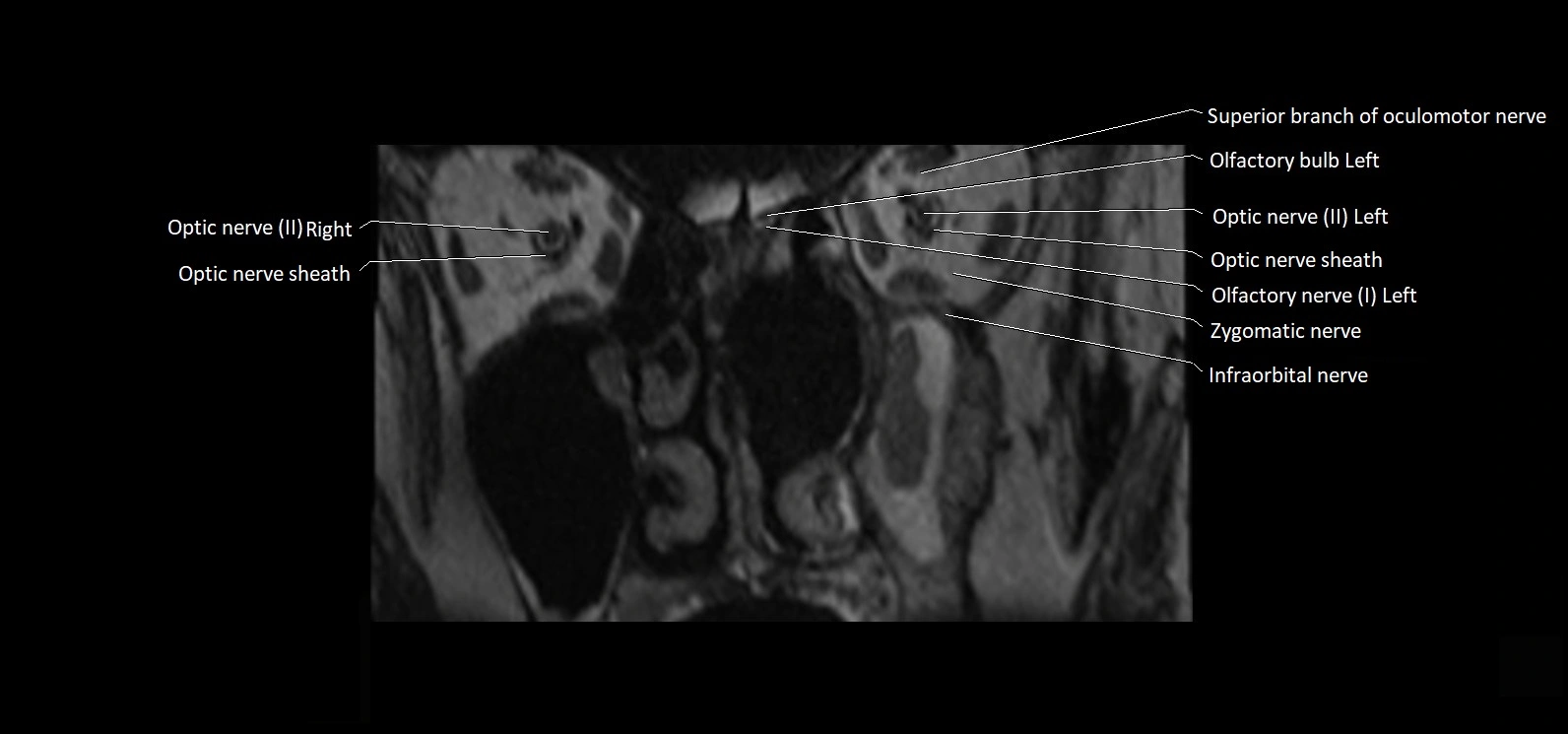 Cranial nerve cross sectional anatomy coronal 3T MRI image 5.webp